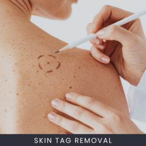 How Skin Tag Removal Works and When to Consider It